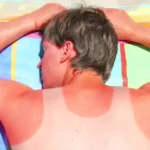 How to Relieve Sunburn Itch: Effective Tips and Remedies