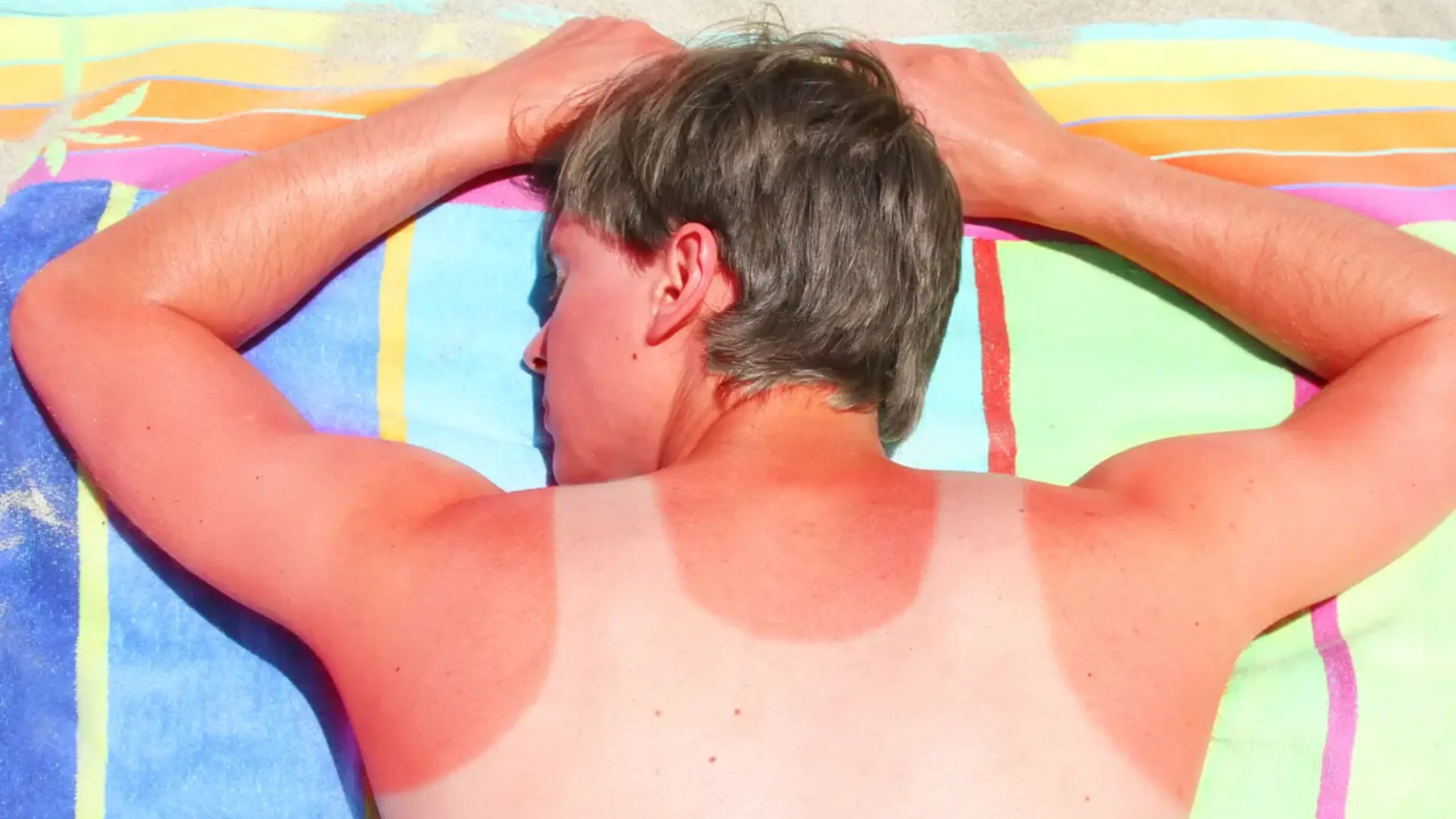 How to Relieve Sunburn Itch Effective Tips and Remedies